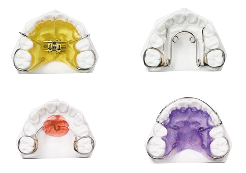 子どもの歯列矯正に使用する器具4パターン