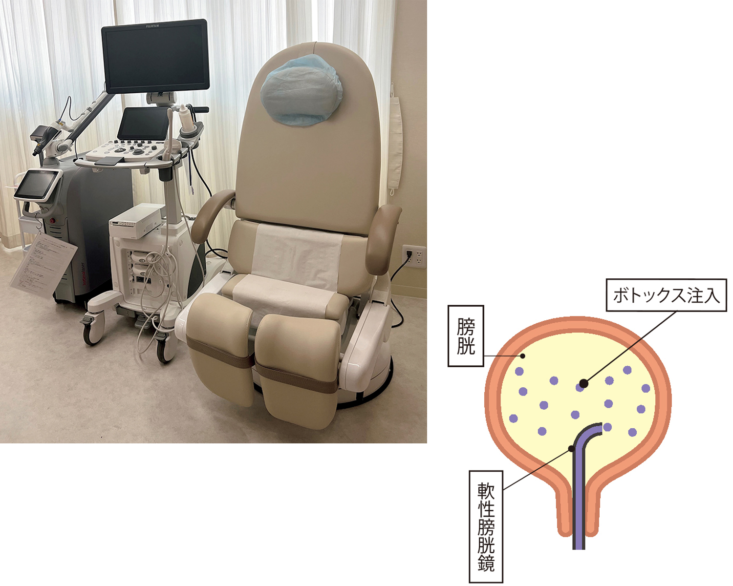 膀胱ボトックス